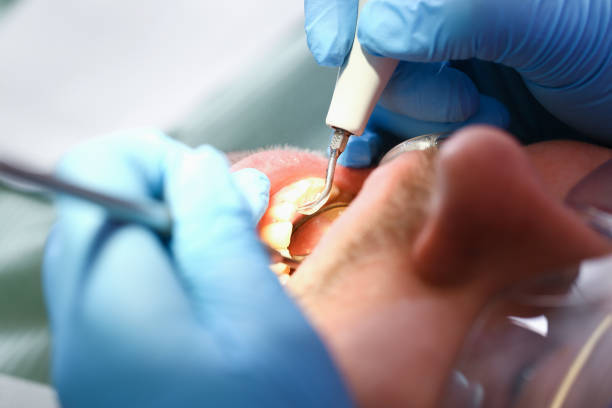 Best Emergency Root Canal Treatment in West Branch, MI